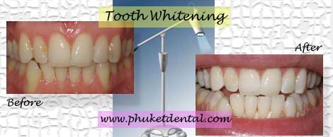 Tooth Whitening:Coldlight,non-LASER,LED,Natural Plus at Phuket Dental Clinic,Thailand